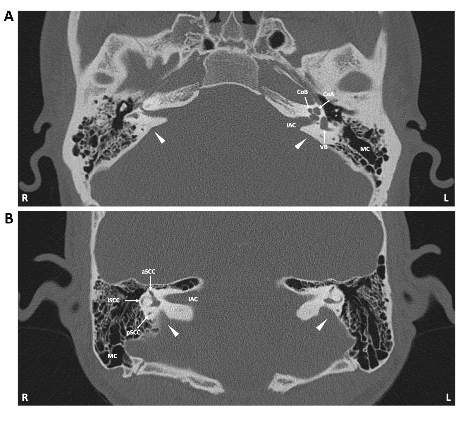 Fig. 3. A, computed tomography of the temporal bones of a normal hearing adult. Axial plane, bone window: Unremarkable findings with no signs of enlarged vestibular aqueduct (arrowhead). B, computed tomography of the temporal bones of a 7-year-old male patient with hearing loss and biallelic pathogenic homozygous variants in the SLC26A4 gene coding for protein variant p.Y78C. The patient (patient #681), his clinical findings, and the molecular features of the SLC26A4 protein variant have been described in our recent publication [135]. Axial plane, bone window: Prominent bilateral enlarged vestibular aqueduct (arrowhead). aSCC, anterior semicircular canal; CoA, cochlear apex; CoB, cochlear basal turn; IAC: internal acoustic canal; L, left; lSCC: lateral semicircular canal; MC: mastoid cavity; pSCC: posterior semicircular canal; R, right; VB, vestibulum.