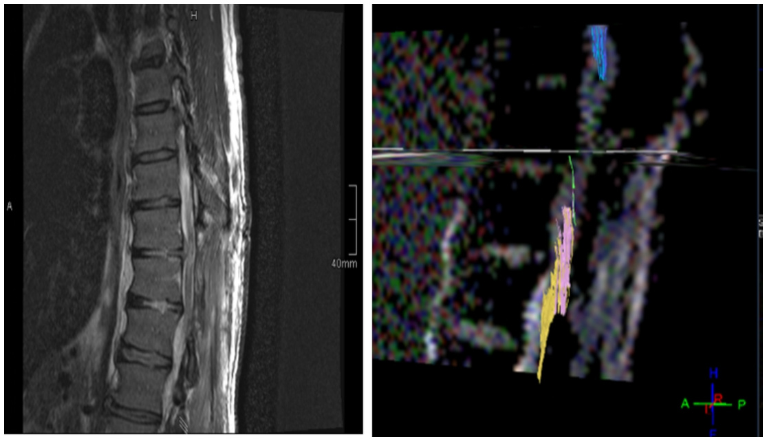 Fig. 2. 48 y.o. male with compressive myelopathy following disc herniation at level Th10/Th11. Patient had paraparesis AIS C. SSEP and MEP from upper limbs were normal and were absent from lower limbs. MR DTI shows discontinuation of fiber tracts at the level of injury.