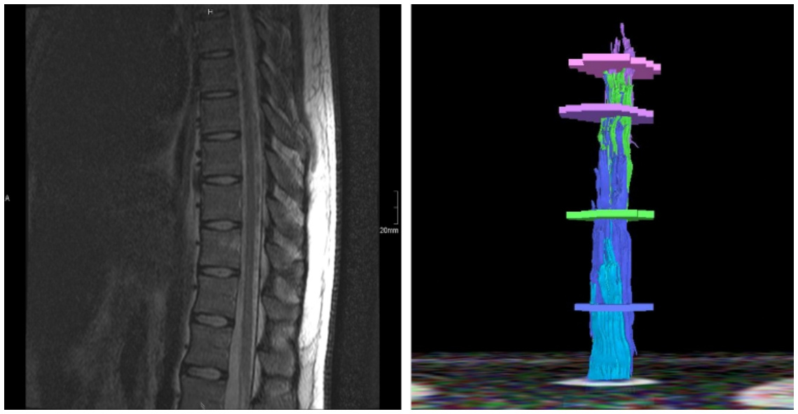 Fig. 4. 19 y.o. male with psychogenic paraparesis after stair fall. SSEPs and MEPs were normal. MRI DTI shows intact fiber tracks.